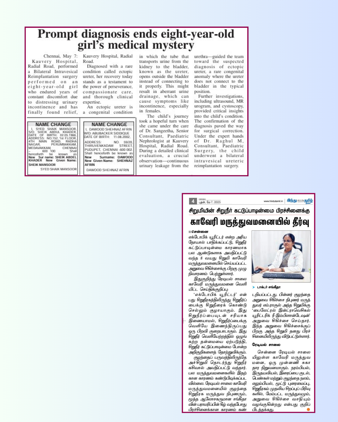 Dr. Raghul Maniam - Ectopic Ureter Reimplantation in The Hindu Tamil Dr. Raghul Maniam pediatric urologist in The Hindu Tamil: Bilateral Ectopic Ureter Reimplantation curing 8 years of urinary incontinence at Kauvery Hospital Chennai